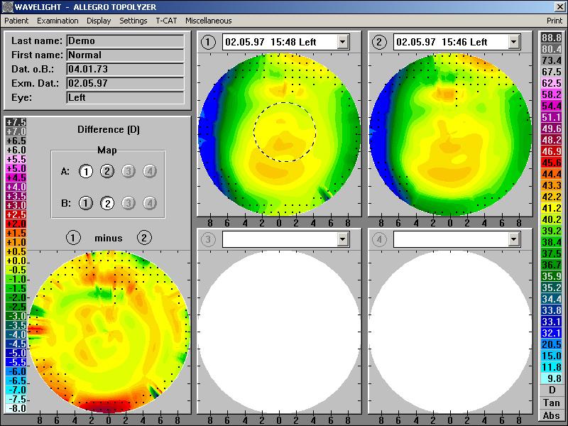 ALLEGRETTO Wave Eye-Q: интерфейс сравнения карт для планирования лечения